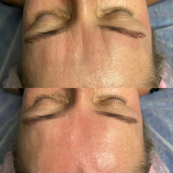 Ліфтинговий масаж обличчя у Києві - ефект