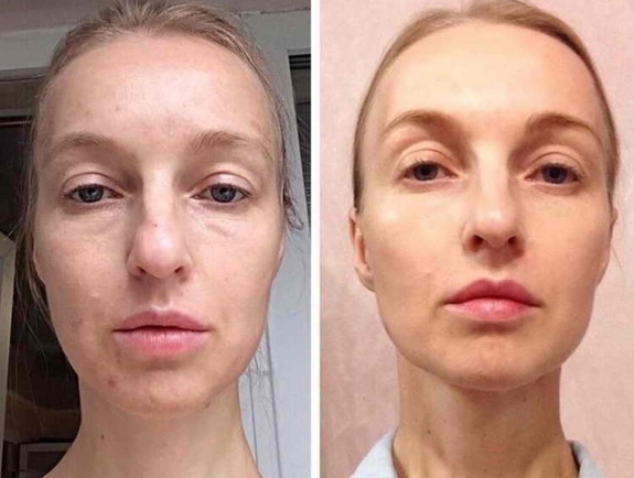 Результат после процедуры массажа лица Львов