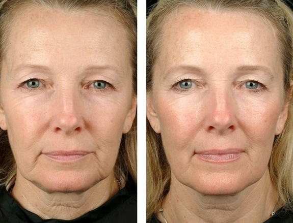 Массаж лица Львов - эффект до и после