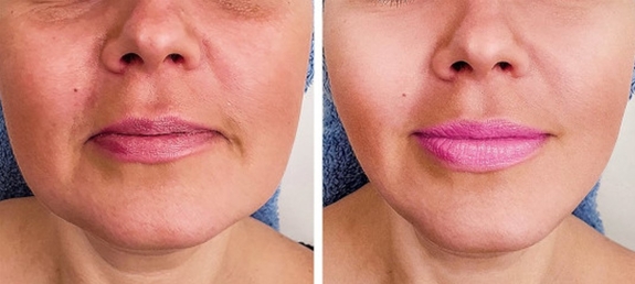 Буккальный массаж лица Одесса - эффект до и после