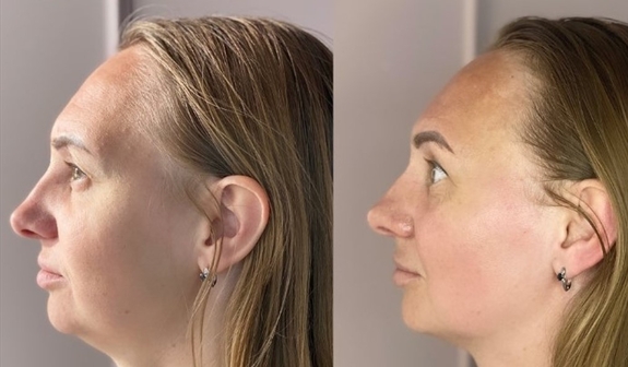 Лифтинг массаж лица - результат после курса процедур
