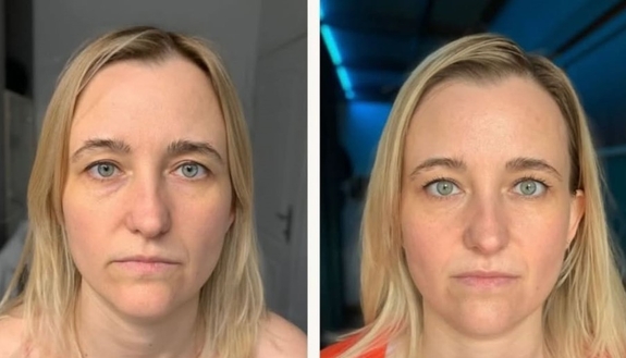 Лімфодренажний массаж обличчя - ефект від пешого сеансу