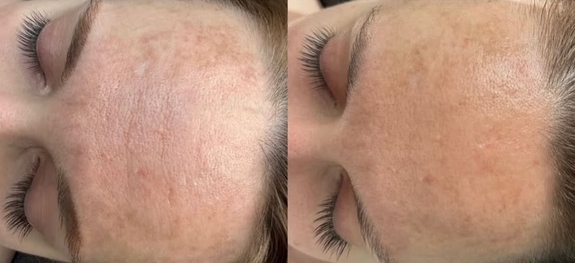 Ліфтинг масаж обличчя зменшує прояв заломів