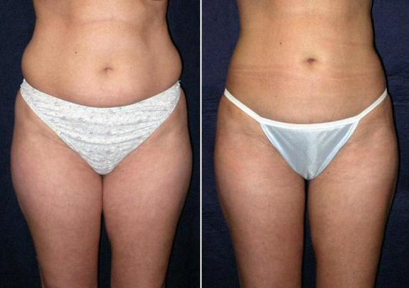 Эффект от миостимуляции живота