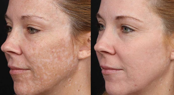 Результат химического пилинга лица