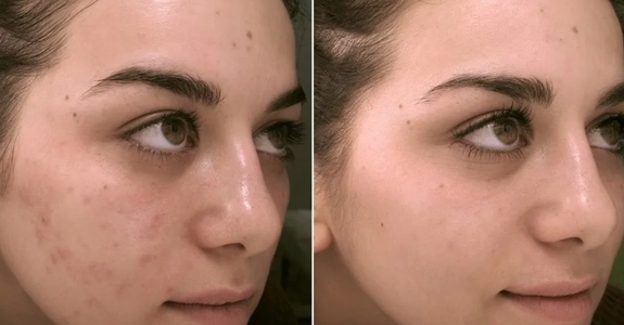 Результат кислотного пілінгу