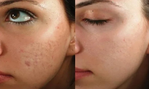 Ефект карбонового пілінгу