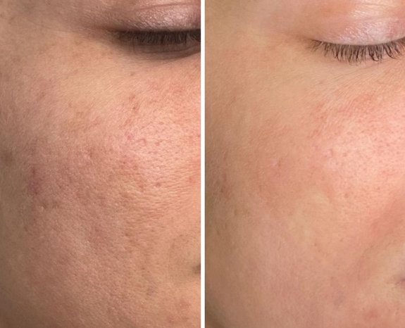 Ефект від хімічного пілінгу