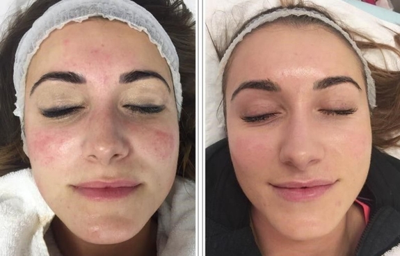 Результат ферулового пилинга