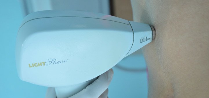 Лазерная диодная эпиляция Light Sheer в центре «Медлайн» в Харькове. Делайте по акции.