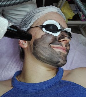Лазерний карбоновий пілінг у центрі апаратної косметології «ASA Laser Cosmetic» у Києві. Записуйтесь на процедуру акції.