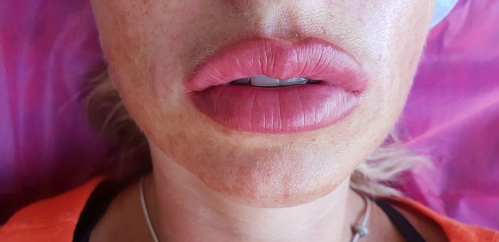 Lip augmentation with hyaluronic acid at the “health derma” cosmetologist in kharkov. sign up for the promotion.
