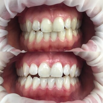 Професійне відбілювання зубів в «dental beauty clinic» в харкові. записатися акцією.