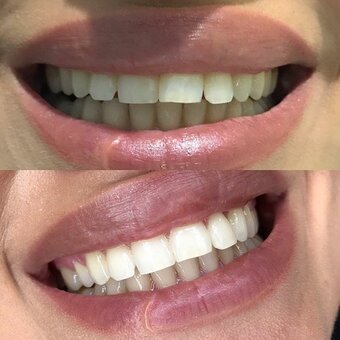 Teeth whitening