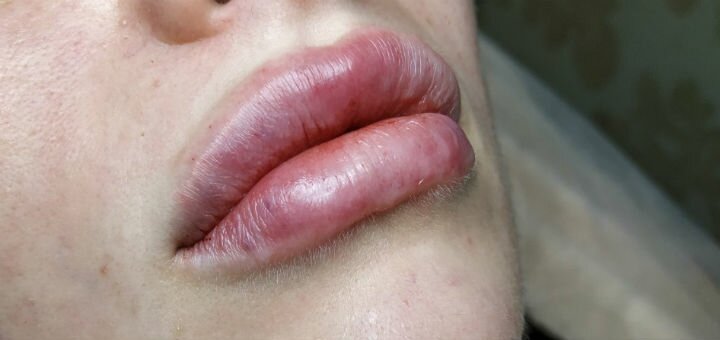 Lip augmentation with fillers at the beautician elena lysak in lviv. sign up for the procedure at a discount.