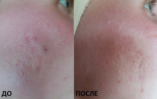 Post-acne treatment in the cosmetology studio of Lyudmila Grushko. Sign up for a discount