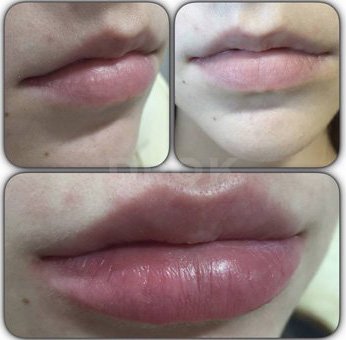 Lip augmentation with fillers at the Victoria beauty studio in Mariupol. Make an appointment with a beautician at a discount.
