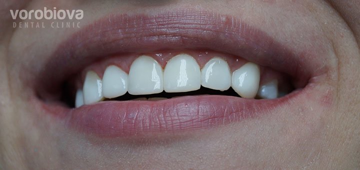 Чищення зубів у клініці Vorobiova Dental Clinic у Дніпрі. Записуйтесь на процедуру зі знижкою.