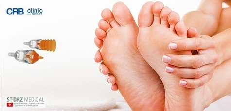 Лечение косточек на ногах -75%!