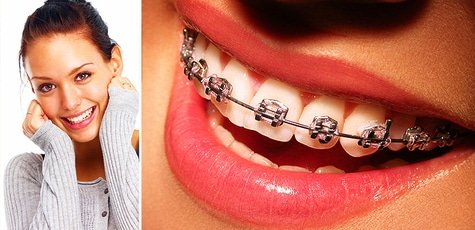 Установка брекет-систем: dr-asatryan.com.ua