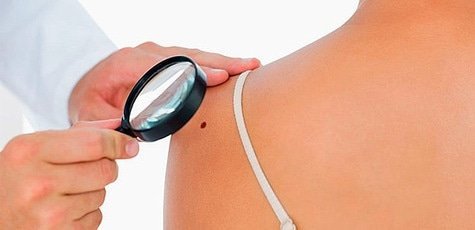 Скидка 65% на удаление родинок в салоне «Мадлен»