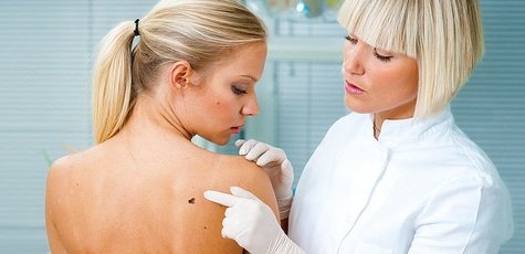 Удаление новообразований от «SensBeauty» -80%!