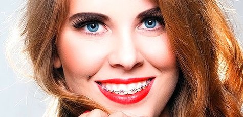 Скидка до 53% брекет-системы в «Денталика»