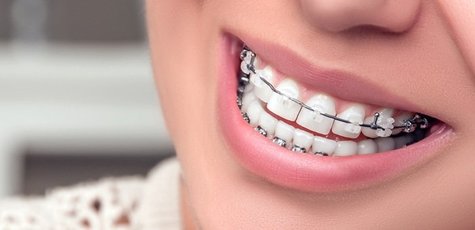 Скидка до 51% на установку брекет-системы