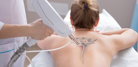 Удаление татуировок и татуажа лазером в «MEDLINE»