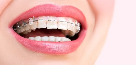 Скидка до 77% на брекет-системы в «KievDental»