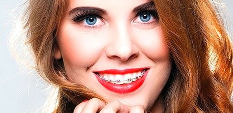 Скидка до 75% на установку брекет-системы