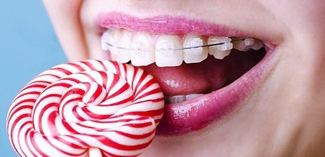 Скидка до 65% на установку брекет-системы