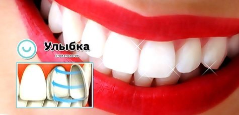 Установка виниров от клиники «Улыбка» -55%
