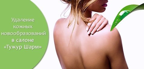 Удаление кожных новообразований -81%