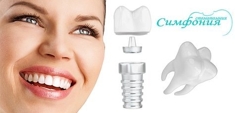 Установка зубных имплантов IHDedental 