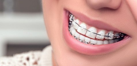 Скидка до 44% на установку брекет-системы