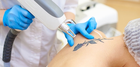 Laser removal of permanent makeup and tattoos