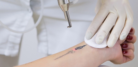 Laser Tattoo Removal at the Sahara Clinic