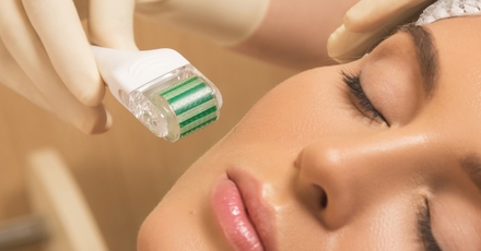 Up to 5 Non-invasive Mesotherapy at Sandra