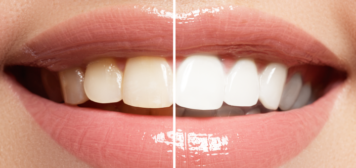 Акція на Відбілювання зубів від стоматолога Аліни Костенко від Pokupon