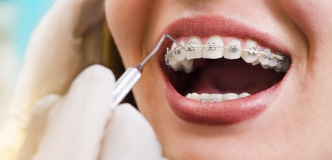 Discount on Braces Installation at «Avicenna Dent»