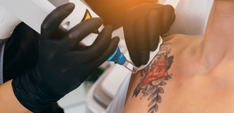 Laser Removal of Tattoos in «Laser secret»