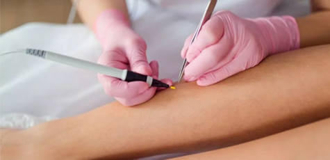 До 4 годин електроепіляції від Бабікян Аліни