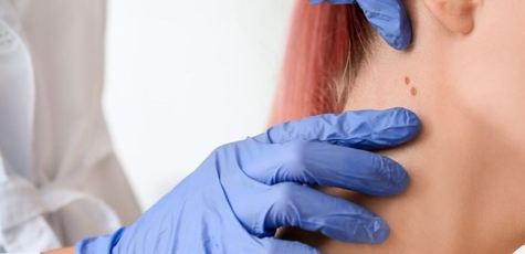 Видалення шкірних новоутворень у «Мед Хілс»