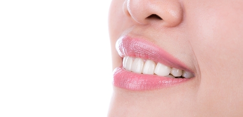 Установка композитних вінірів на передні зуби