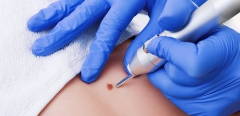 Removal of up to 10 skin lesions