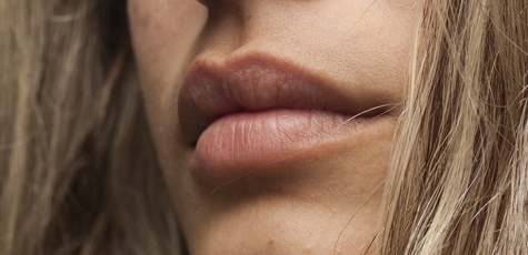 Lip augmentation at the TOP Laser center